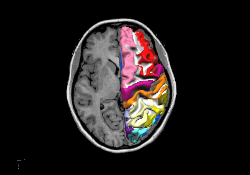 Pineal Gland
